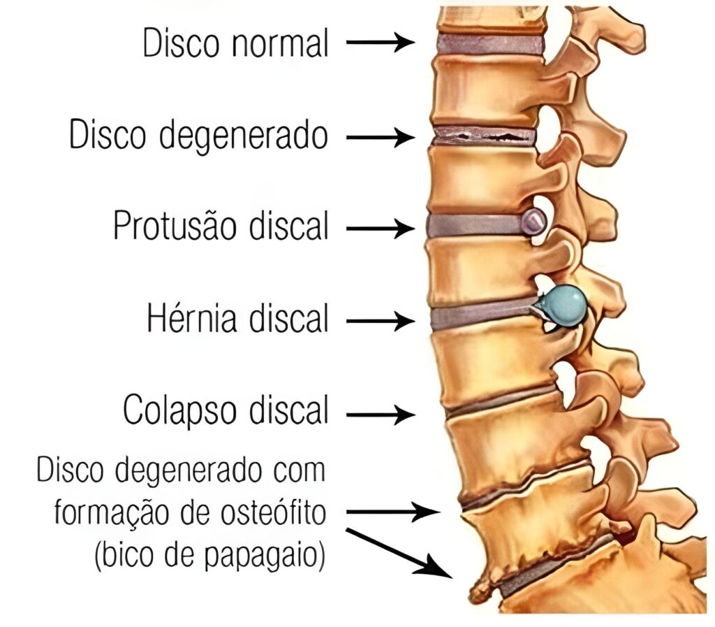 Causas de dor nas costas