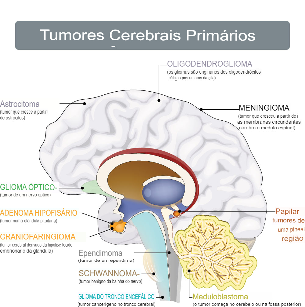 Tumores cerebrais mais comuns e suas localizações principais