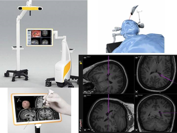 Técnica de Neuronavegação Cerebral