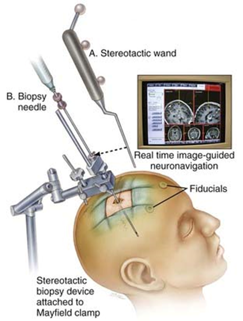 Cirurgia cerebral estereotáxica 